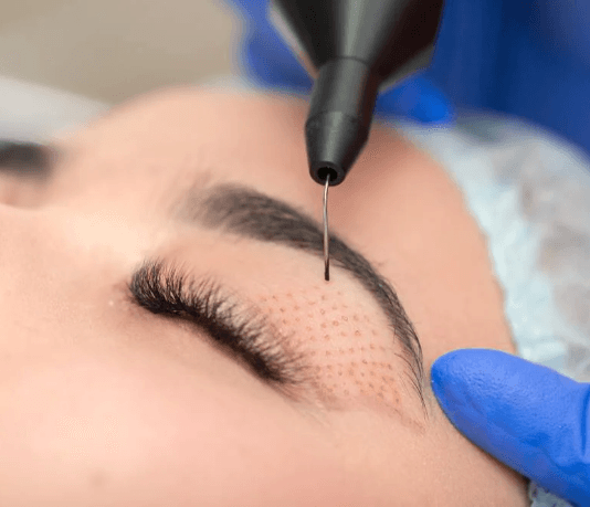 Tratamento de Marcas de Acne com Jato de Plasma